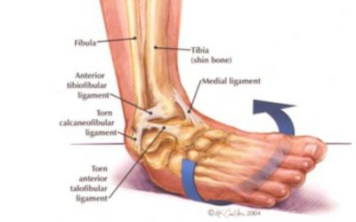 Volleyball Ankle Sprains